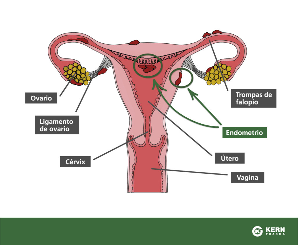 Endometriosis Diagnostico Estadiage Y Tratamiento Doctor Alfredo Escolano 9179